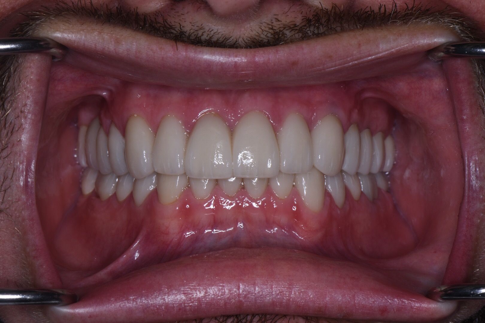 After dental treatment: closeup of bright white, uniformly shaped upper and lower front teeth with full smile.