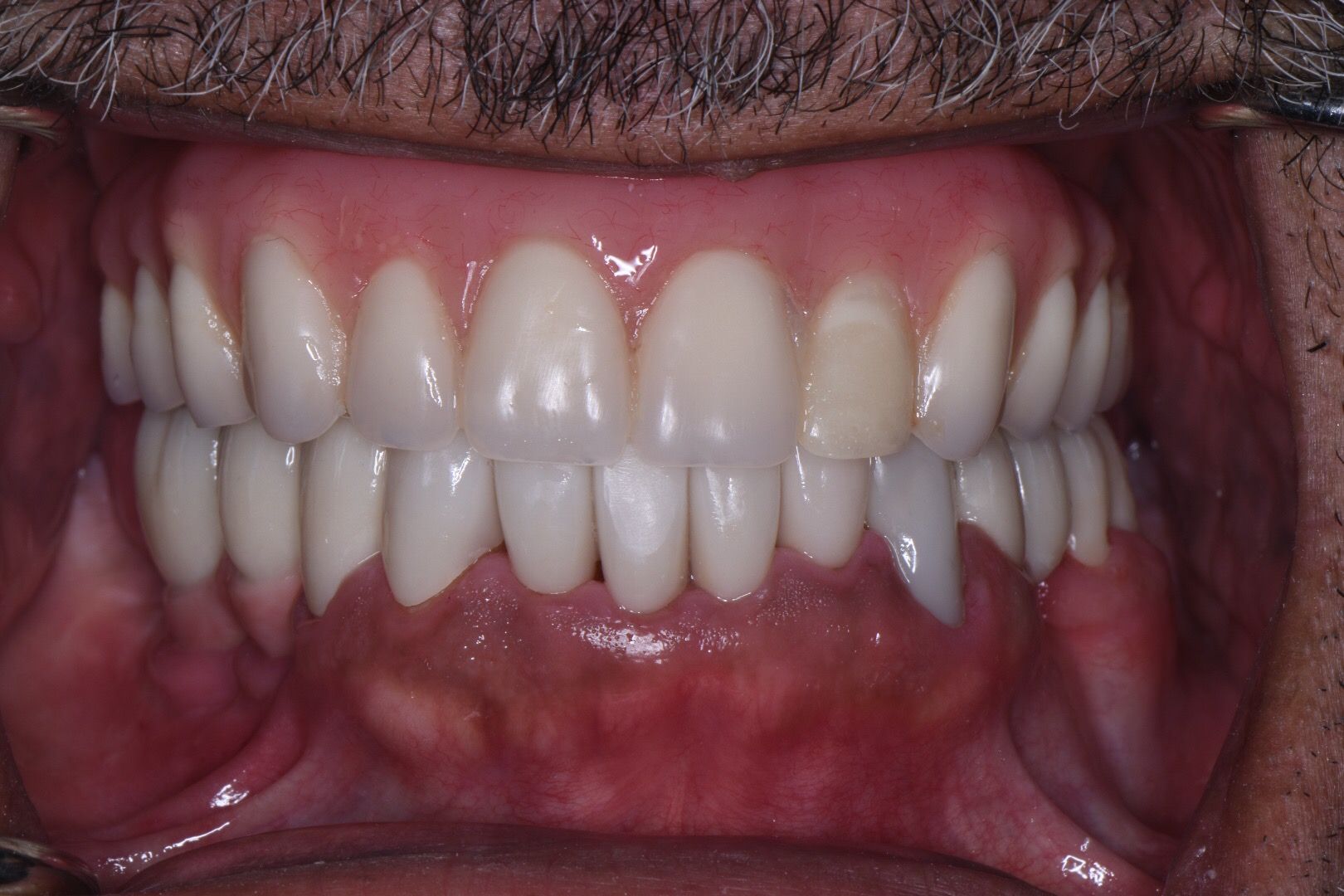 Perler Dental after photo showing restored upper teeth with white crowns and natural lower teeth