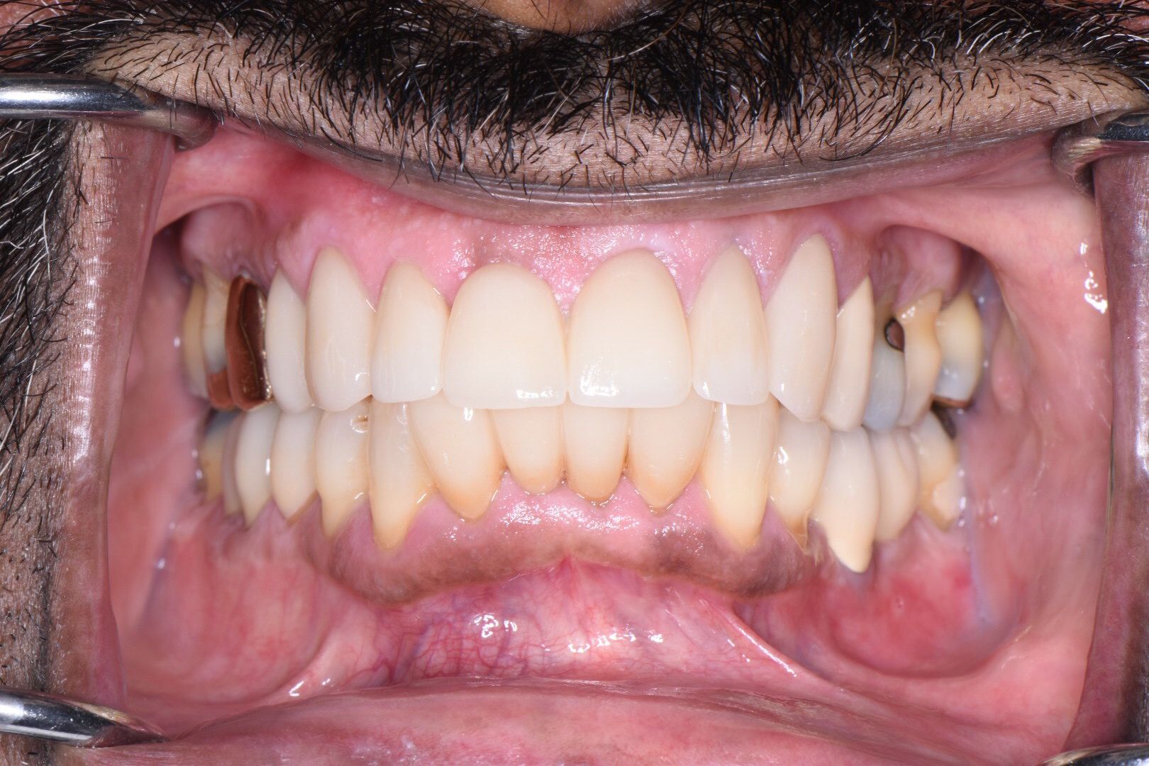 Perler Dental after photo showing full mouth with white restored upper teeth and natural lower teeth