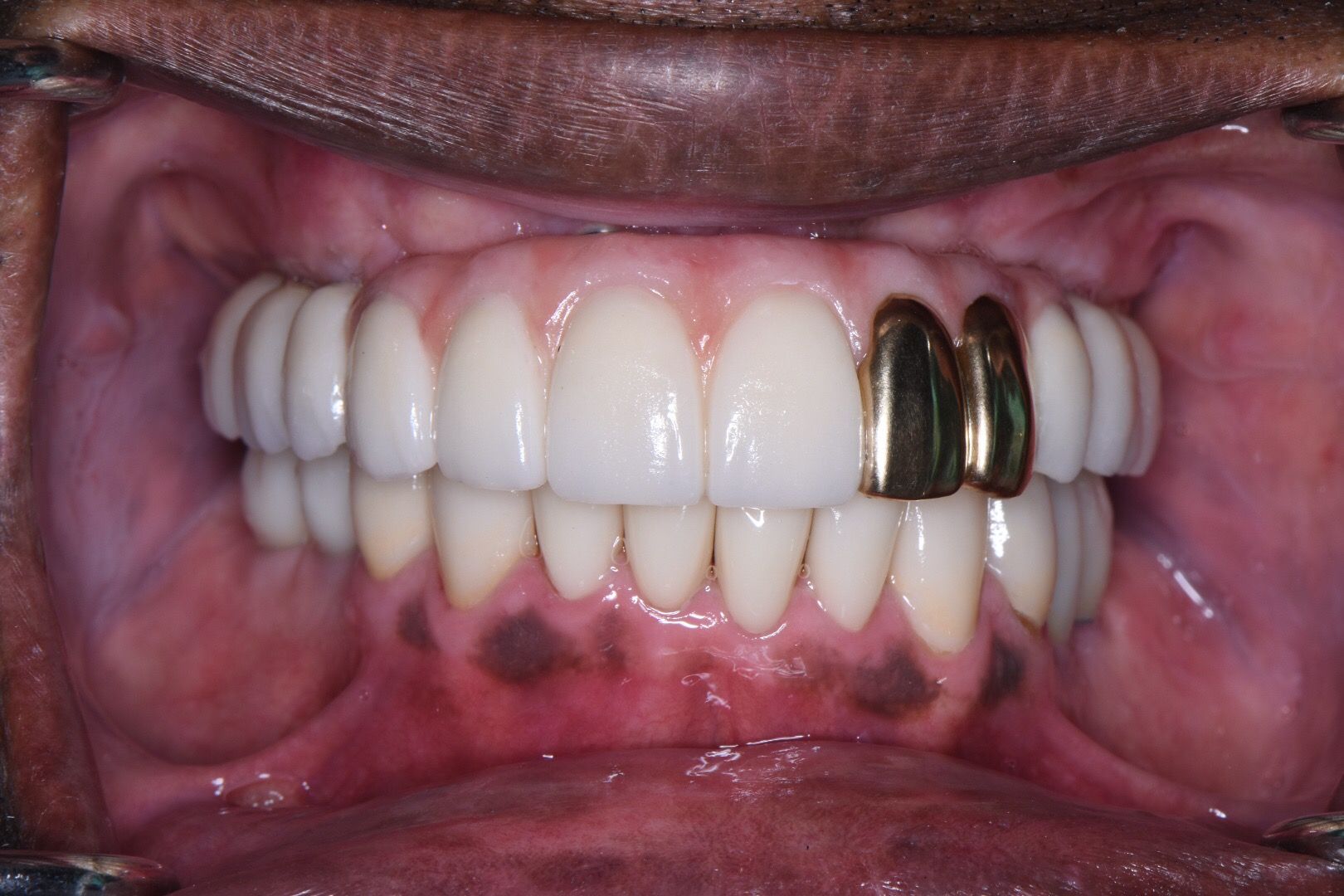 Perler Dental after photo showing upper teeth with white crowns and lower natural teeth in occlusion