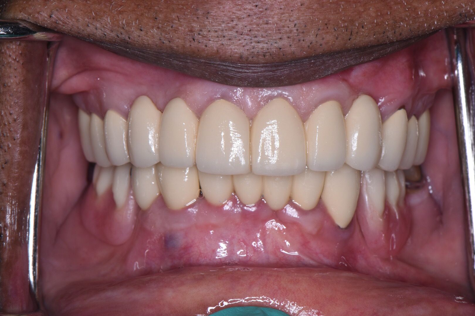 Closeup of restored white teeth with proper alignment after treatment