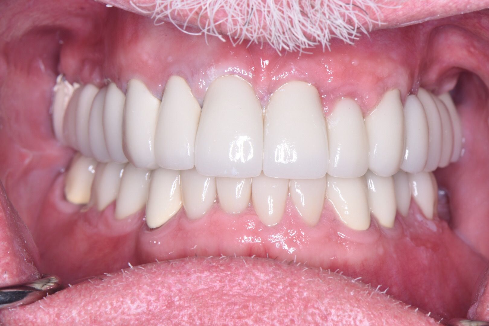 Closeup of bright white, aligned upper and lower teeth after restoration