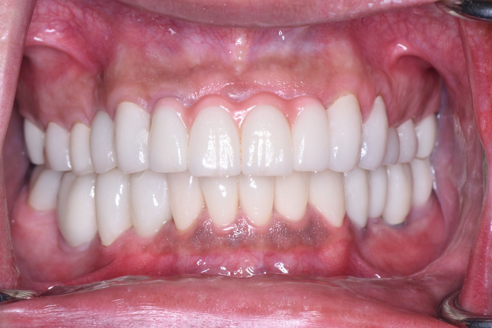 After dental treatment: closeup of white, cosmetically restored upper and lower front teeth with natural contours.