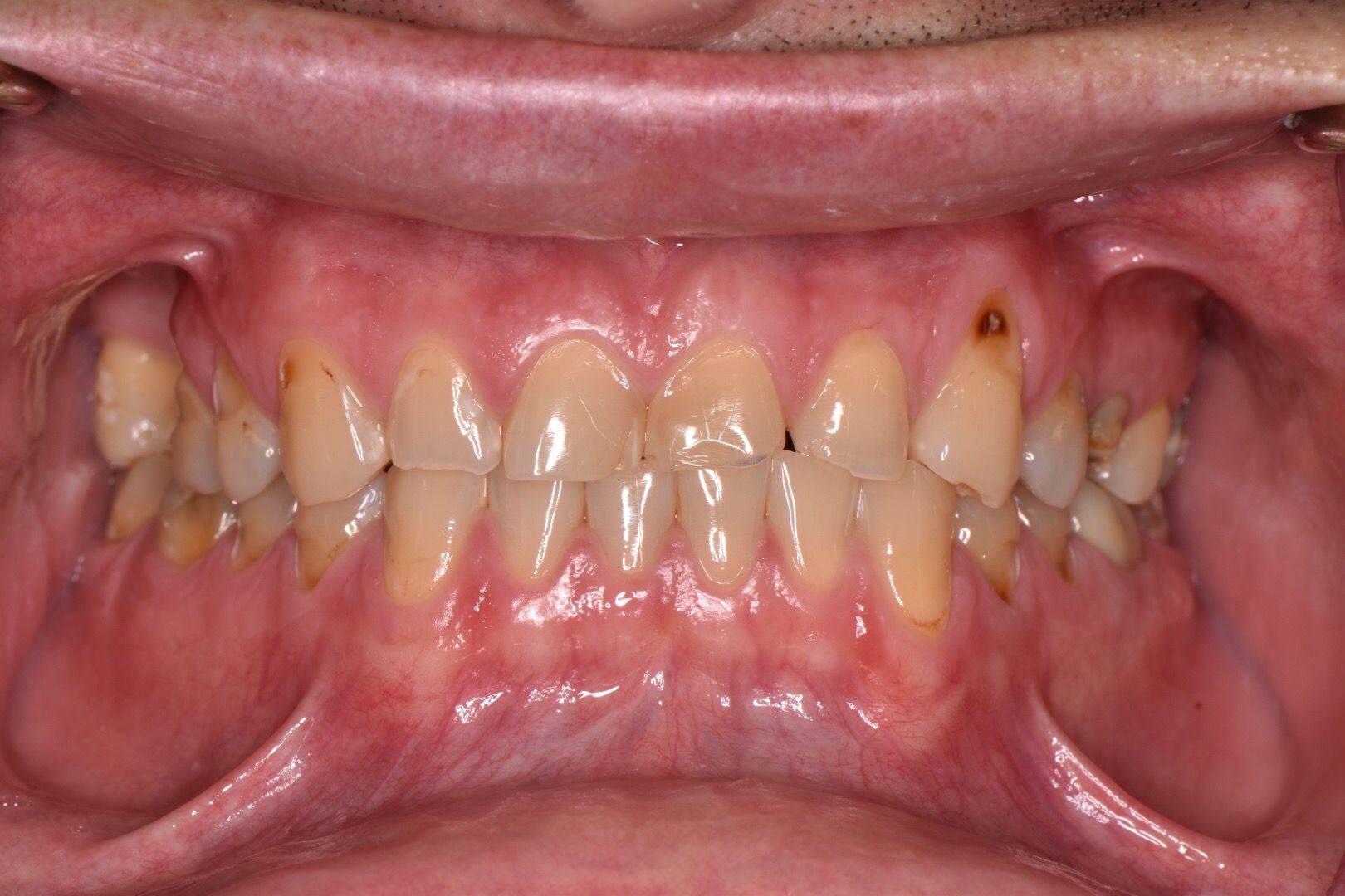 Before dental treatment: closeup of discolored, worn upper front teeth with visible staining and decay.