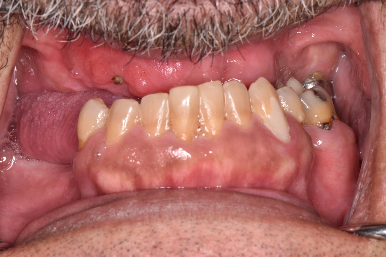 Before photo of upper teeth showing worn, stained natural teeth with recession