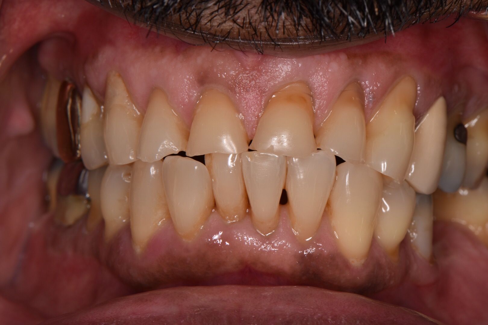 Before photo of upper front teeth showing worn, discolored natural teeth with gaps