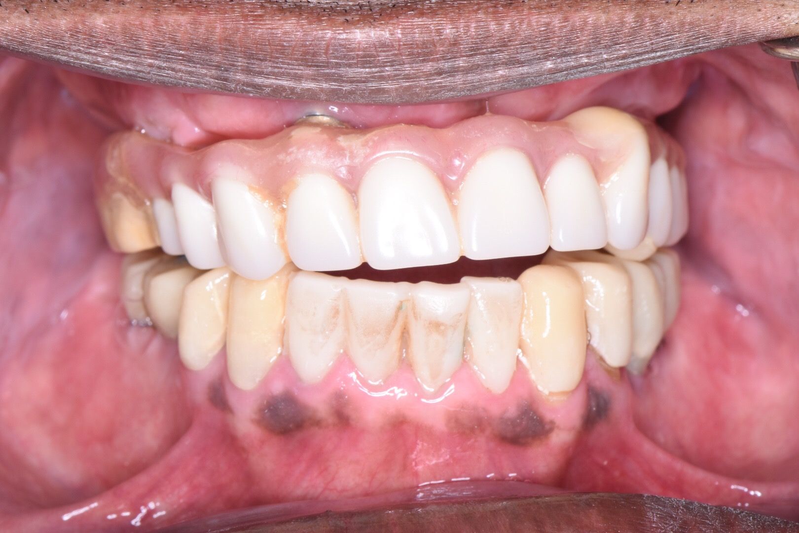 Closeup of upper teeth with discoloration and lower teeth staining before restoration
