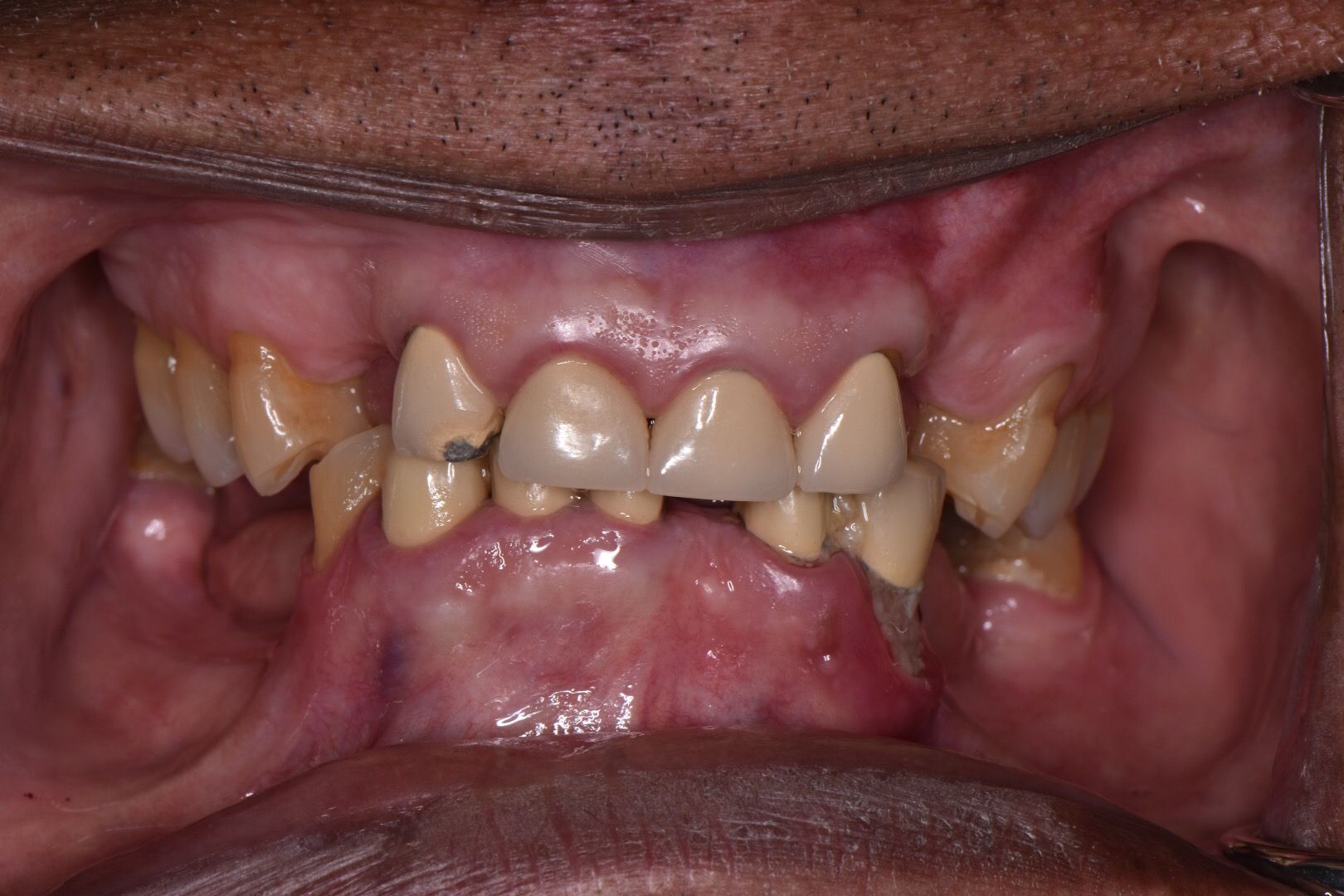 Closeup of damaged, discolored front teeth with gaps before treatment