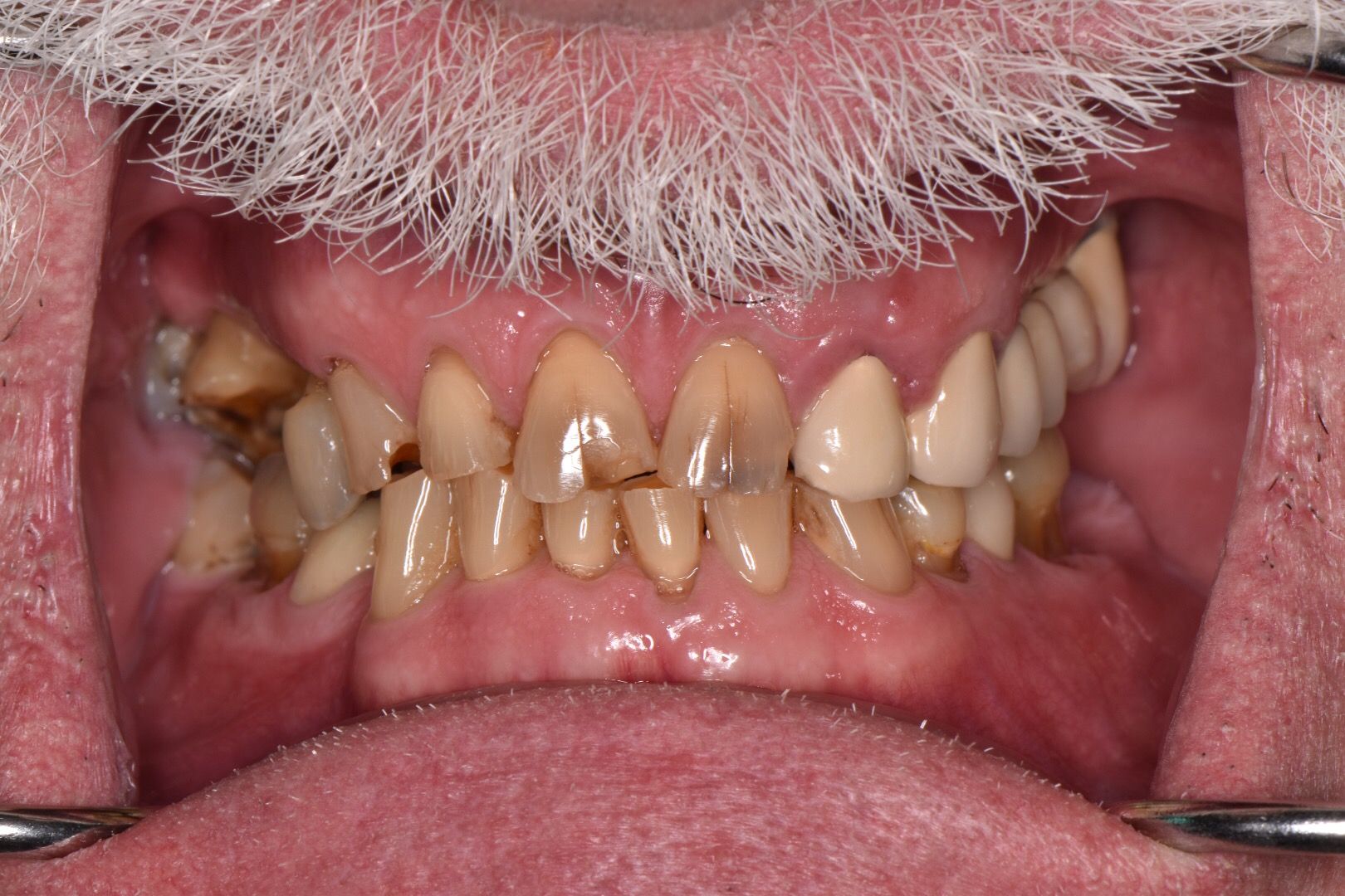 Closeup of discolored, misaligned upper front teeth before treatment