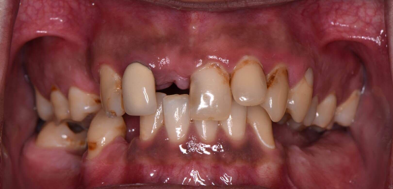 Before dental treatment: closeup of damaged upper front teeth with gap and discoloration.