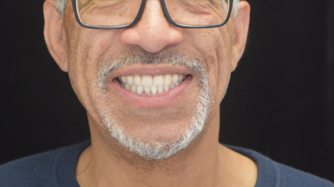 After photo: Same man displaying a complete, white, and aligned smile