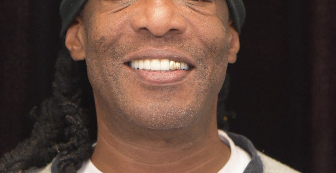 After photo: man with dreadlocks showing bright, aligned smile