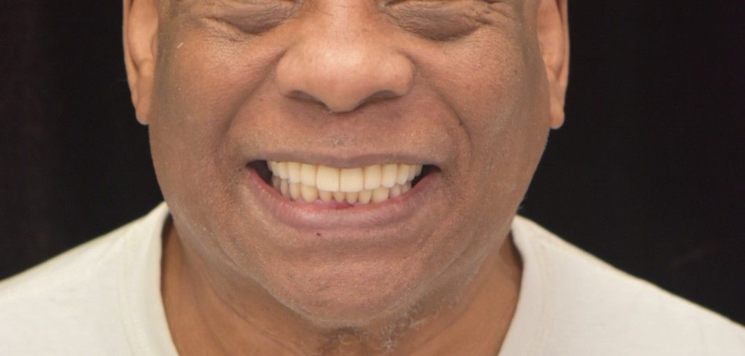 After photo: man with bright, evenly aligned smile against dark background