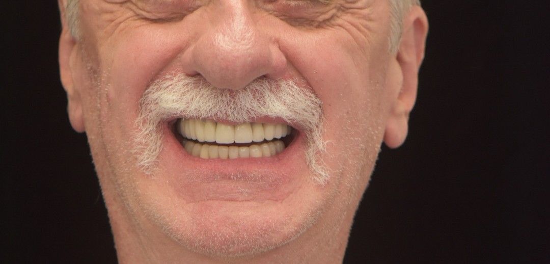 After photo: man with gray beard smiling, showing restored teeth