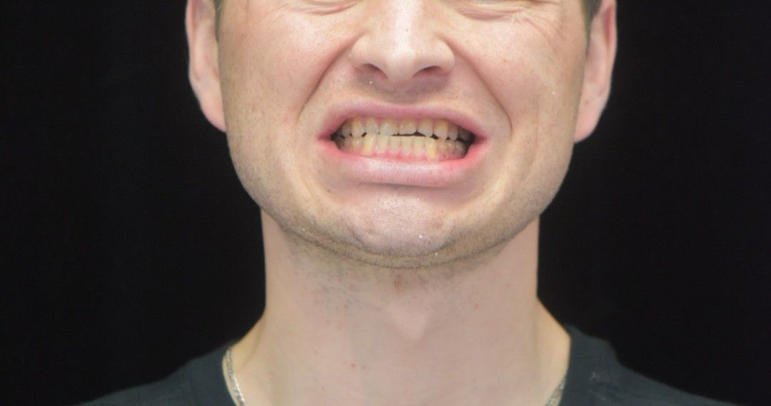 Before photo: Young man with discolored and crowded teeth showing poor alignment