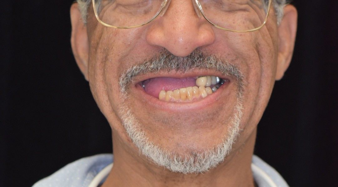 Before photo: Man with yellowed, broken, and missing teeth showing significant decay
