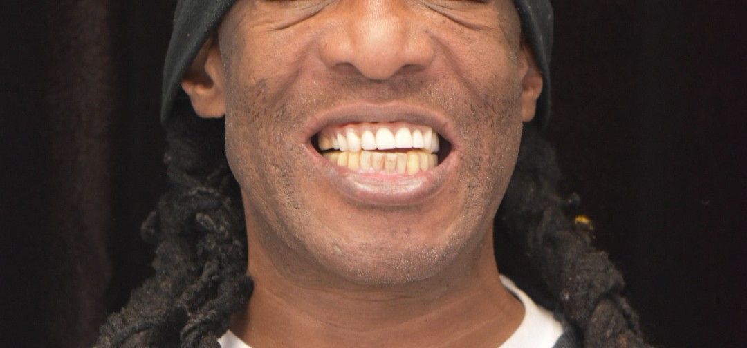 Before photo: man with misaligned and discolored teeth smiling