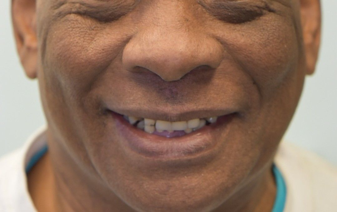 Before photo: man smiling with discolored and misaligned teeth