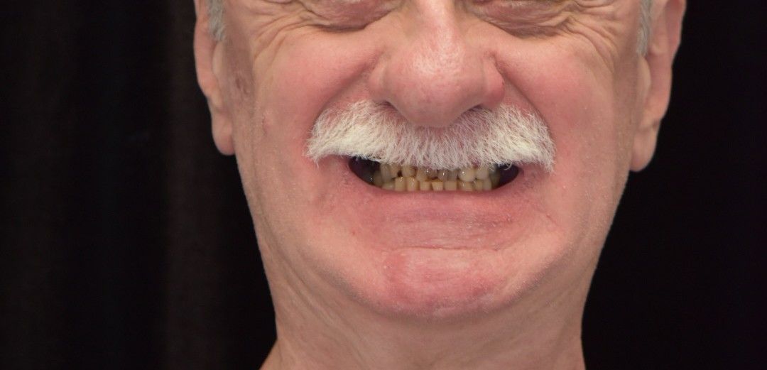 Before dental treatment: patient with mustache showing discolored, worn lower front teeth visible in smile.